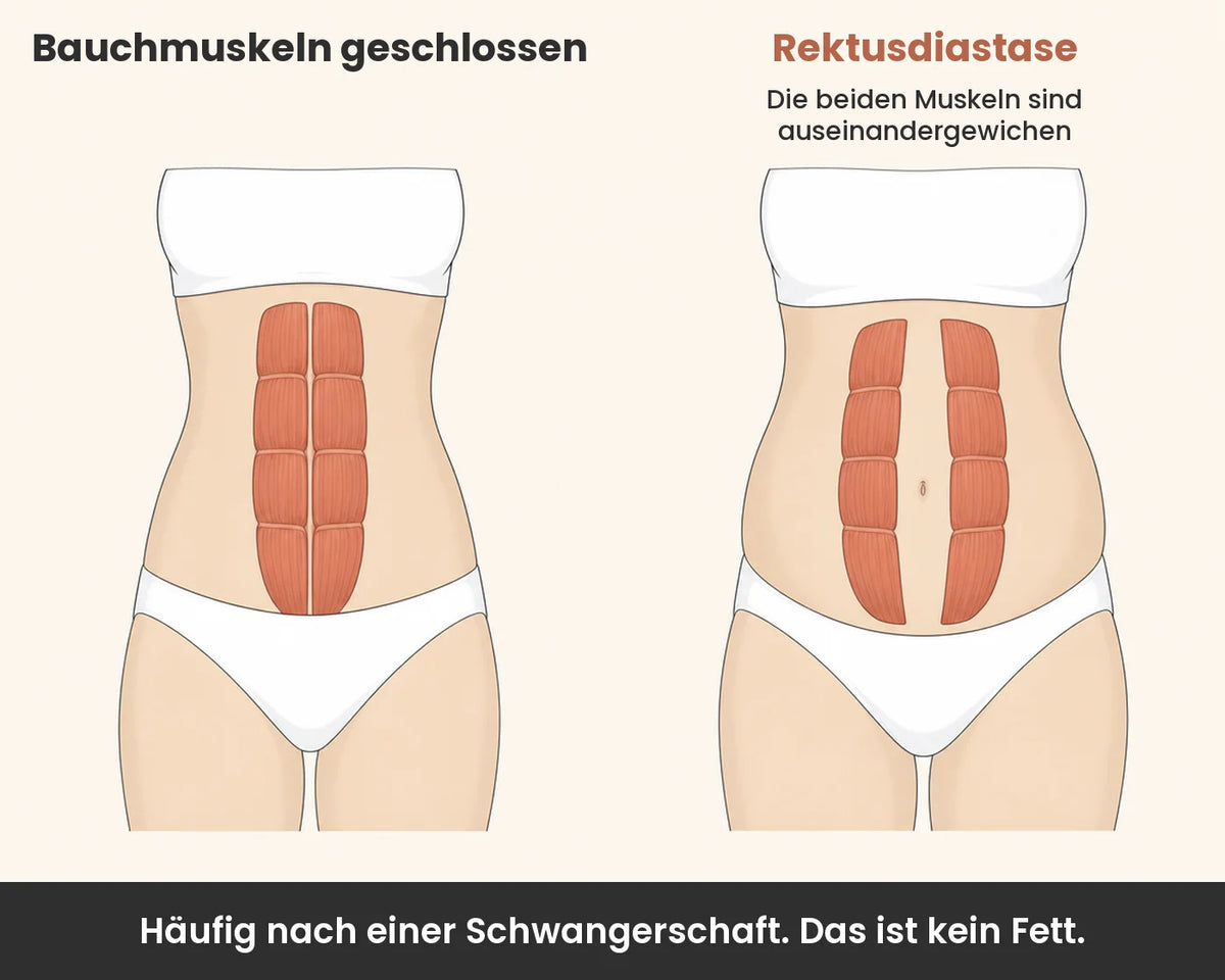 Schéma : abdominaux rapprochés et diastasis
