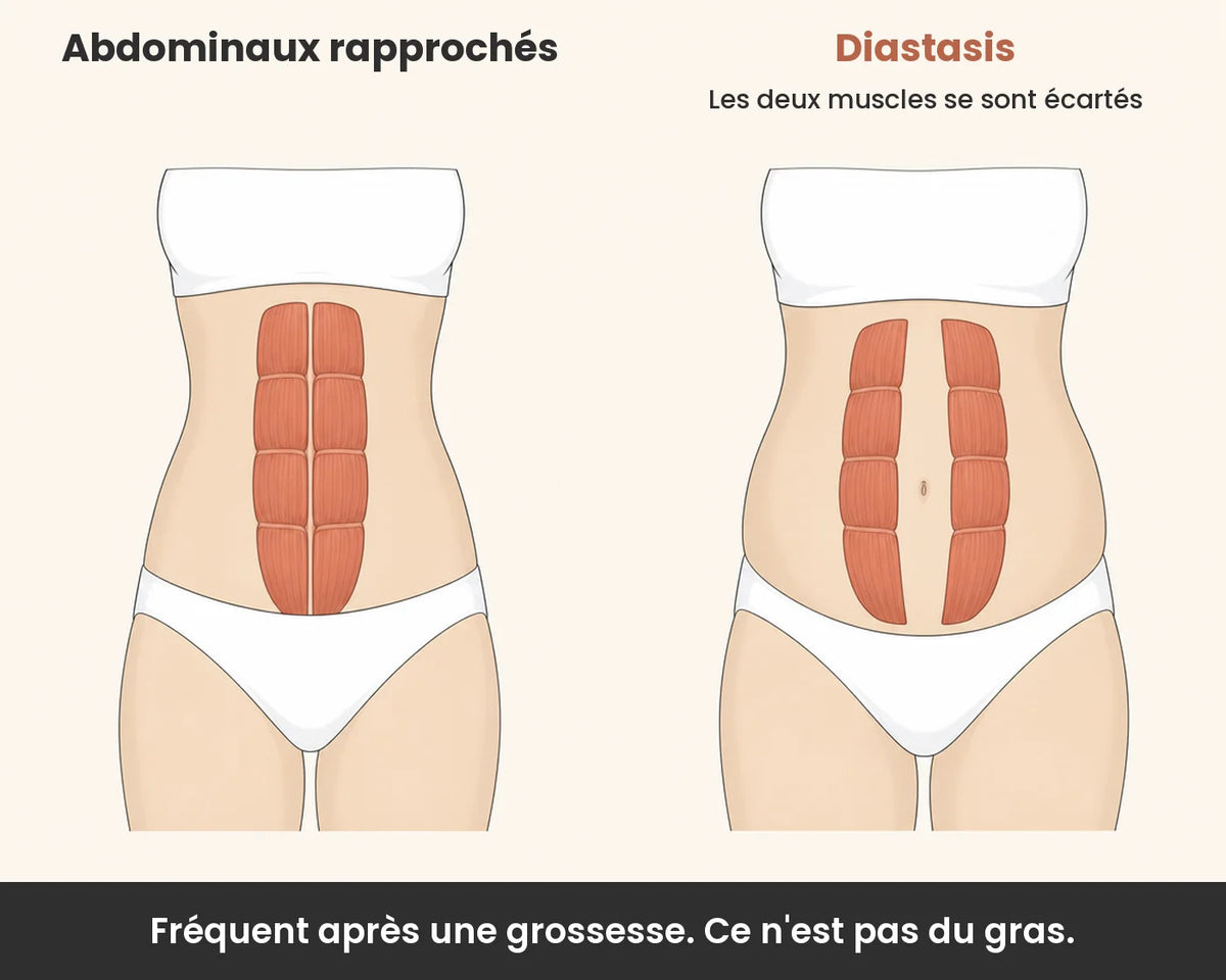 Schéma : abdominaux rapprochés et diastasis